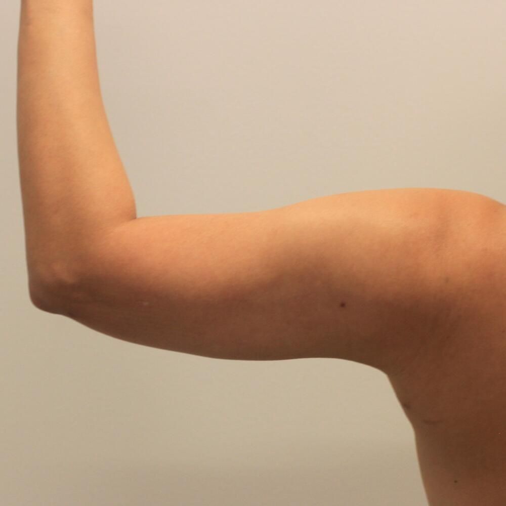 Arm Liposuction Before & After