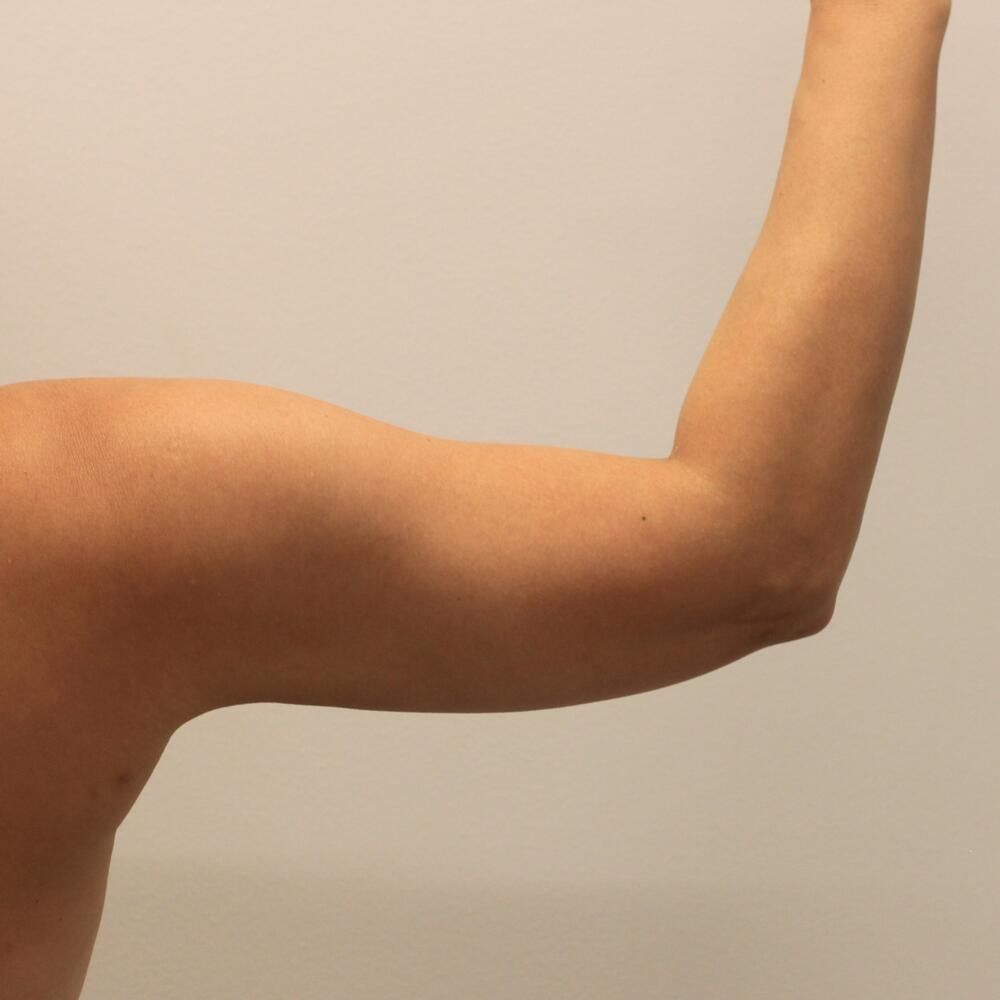 Arm Liposuction Before & After
