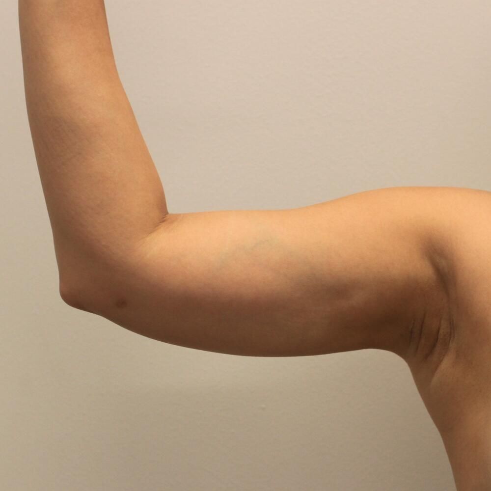 Arm Liposuction Before & After