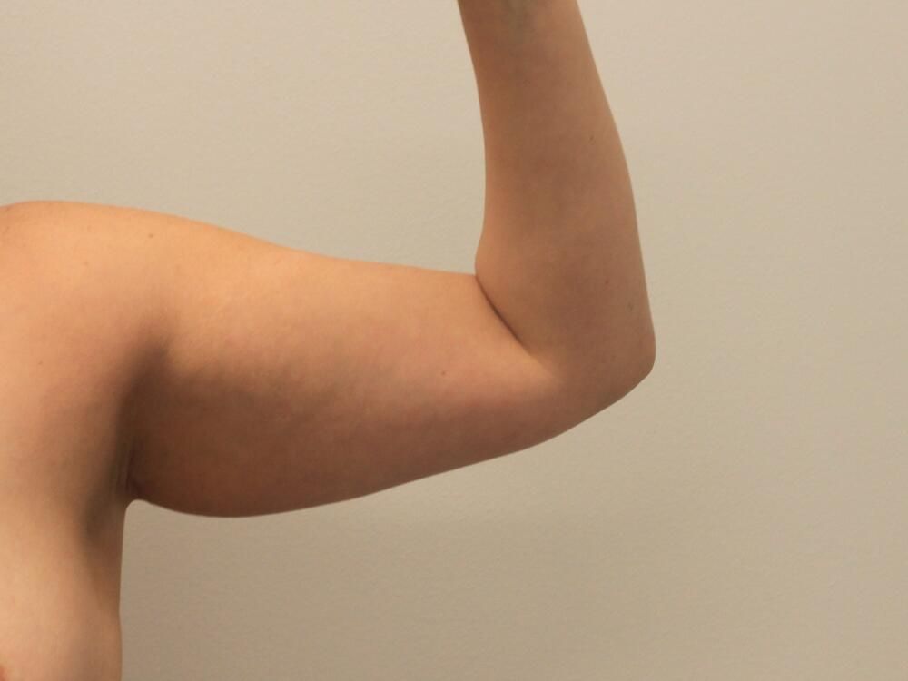 Arm Liposuction Before & After