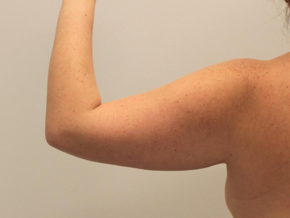 Arm Liposuction Before & After