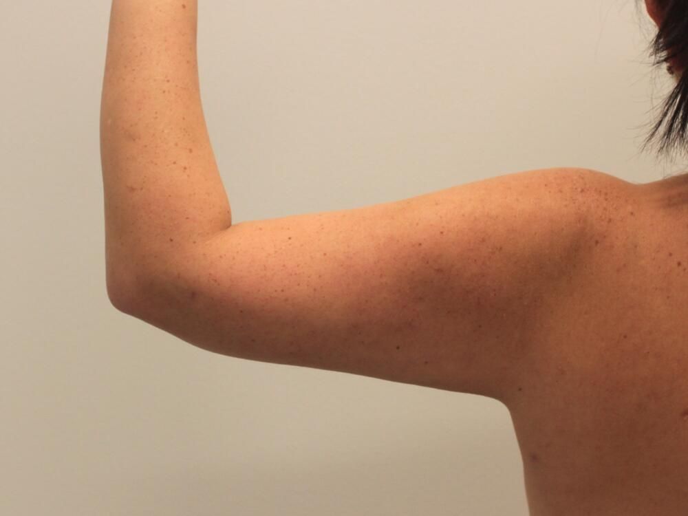Arm Liposuction Before & After