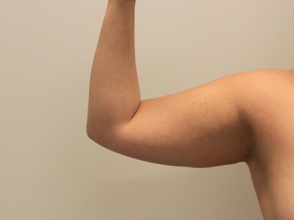 Arm Liposuction Before & After