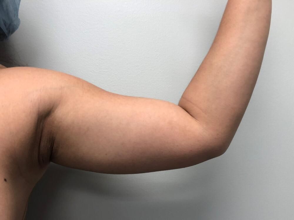 Arm Liposuction Before & After
