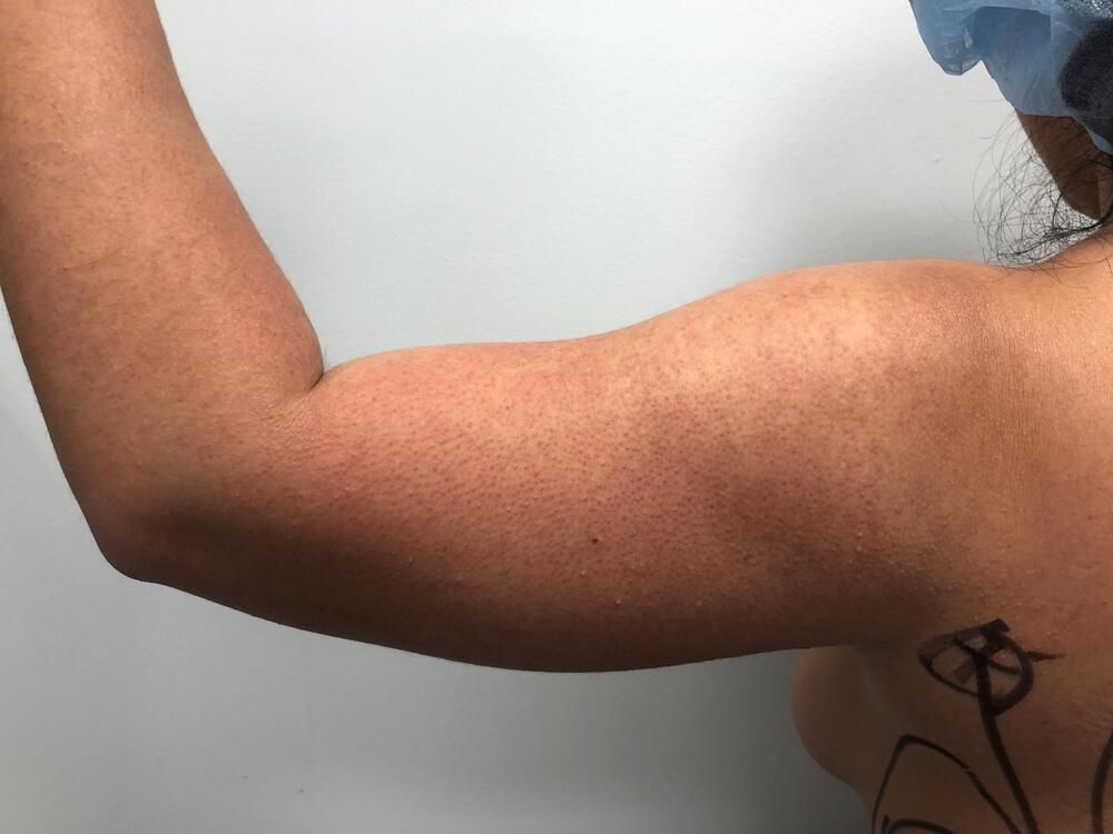 Arm Liposuction Before & After