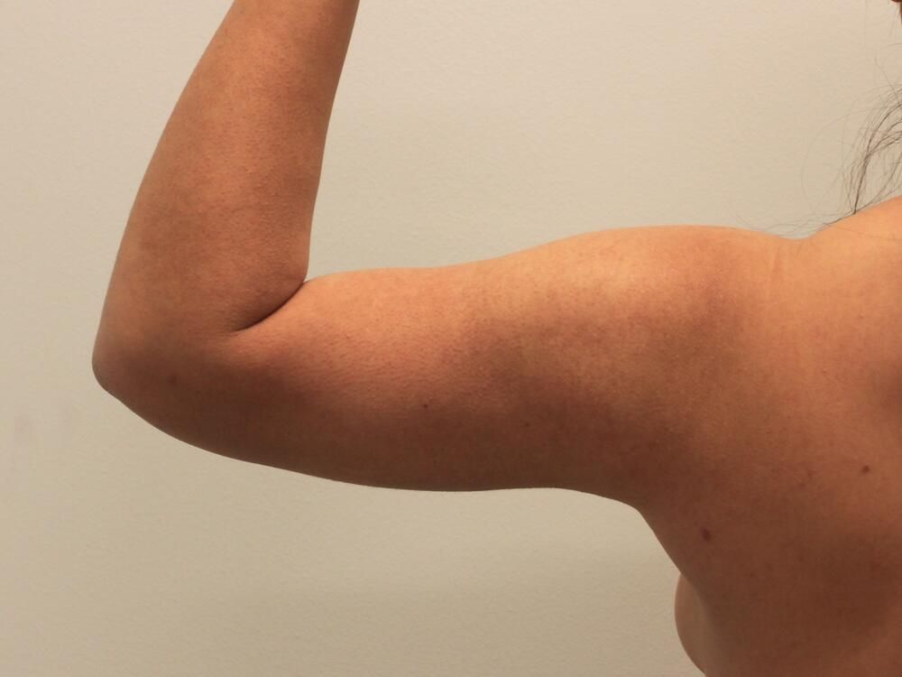 Arm Liposuction Before & After