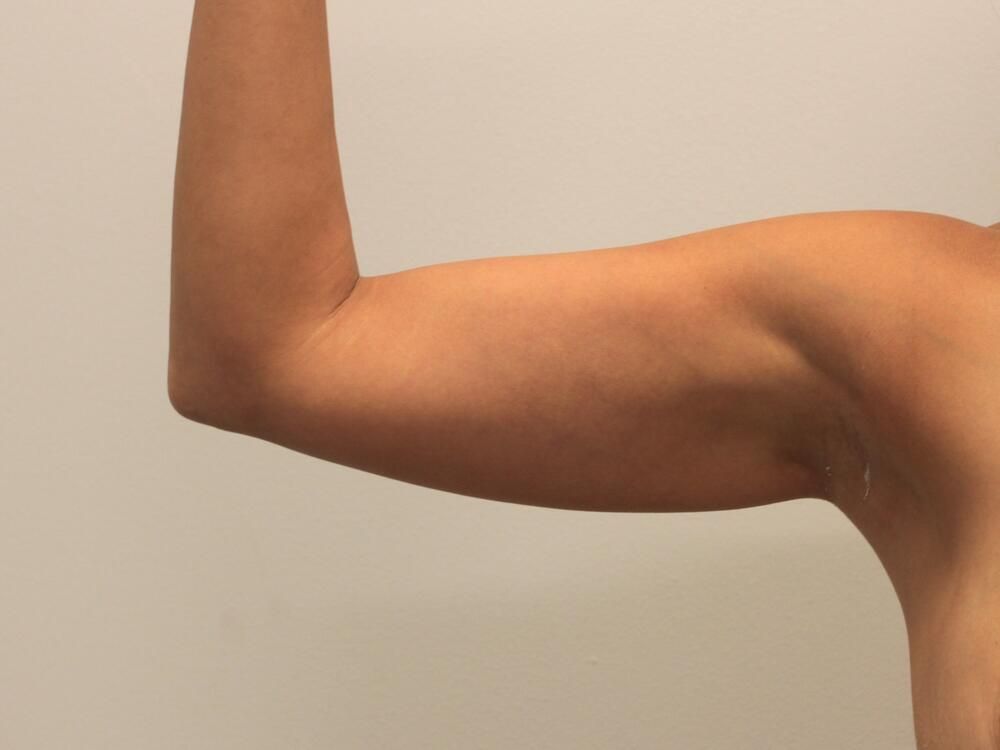 Arm Liposuction Before & After