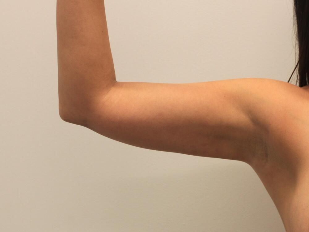 Arm Liposuction Before & After