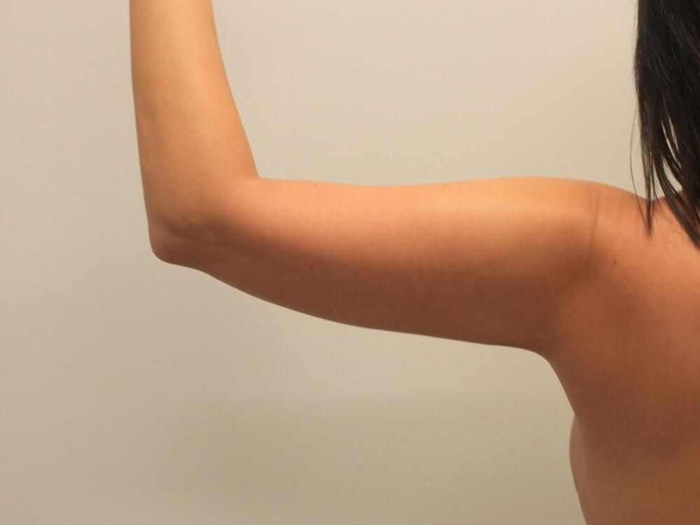 Arm Liposuction Before & After