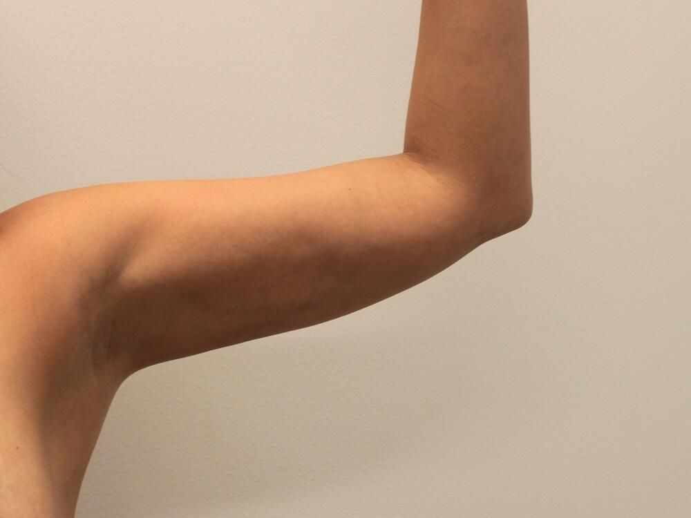 Arm Liposuction Before & After
