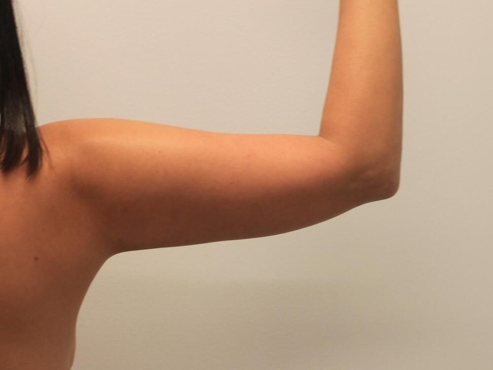 Arm Liposuction Before & After