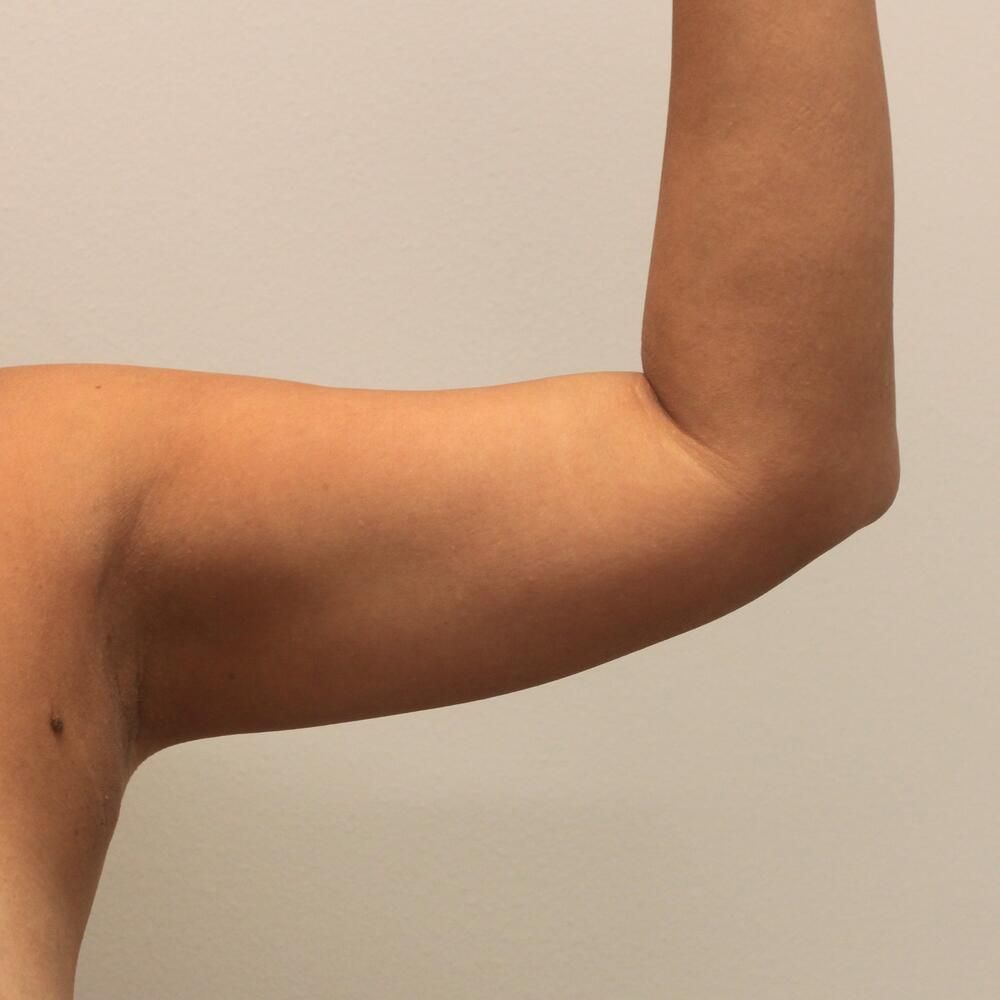 Arm Liposuction Before & After