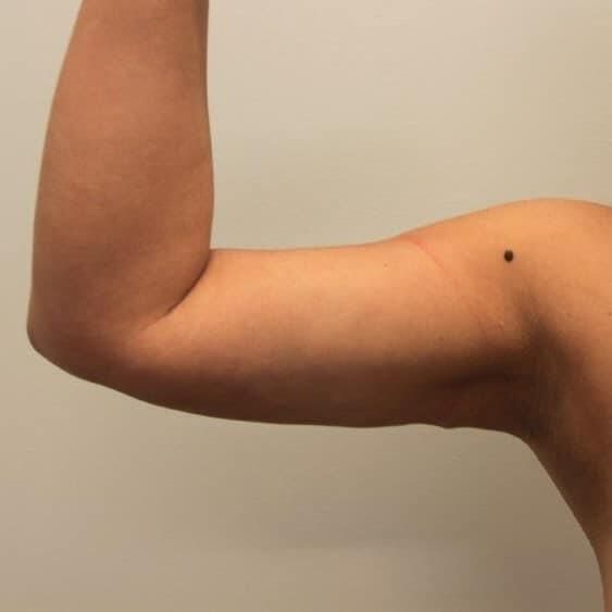 Arm Liposuction Before & After