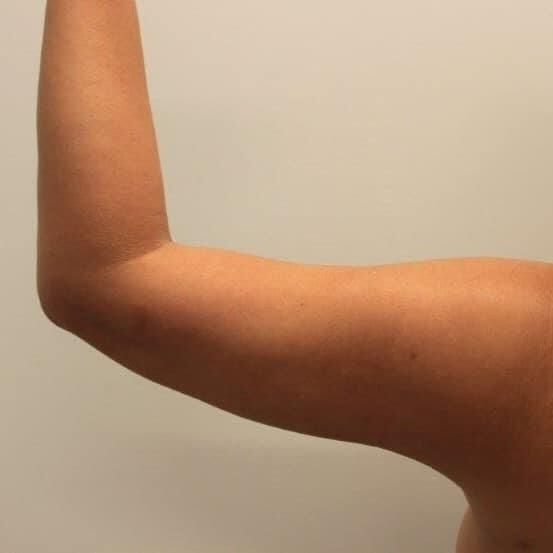 Arm Liposuction Before & After