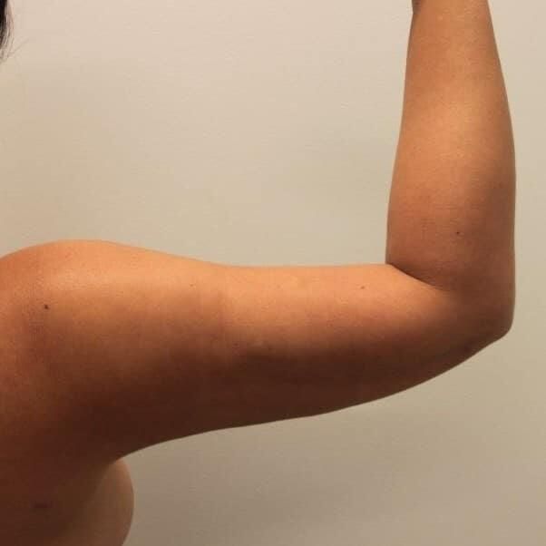Arm Liposuction Before & After
