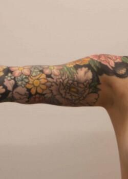Arm Liposuction Before & After