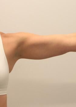 Arm Liposuction Before & After