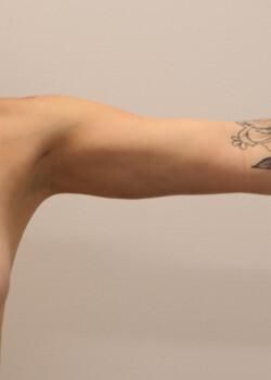 Arm Liposuction Before & After