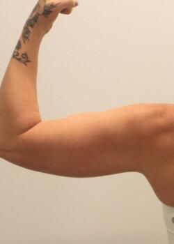 Arm Liposuction Before & After
