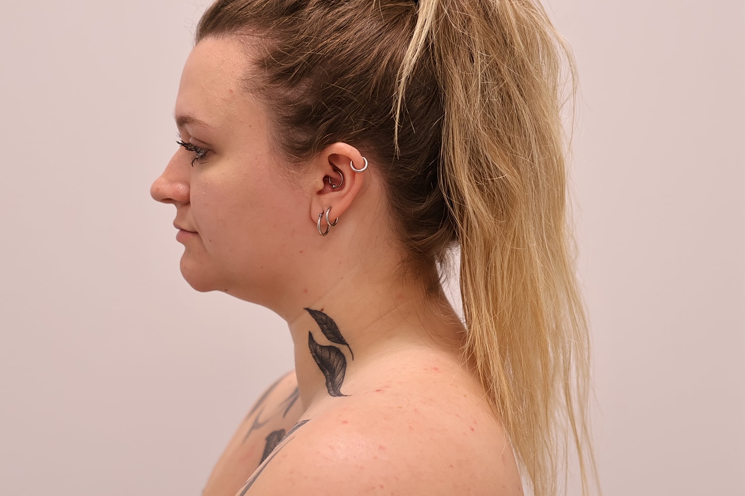 Neck Liposuction Before & After