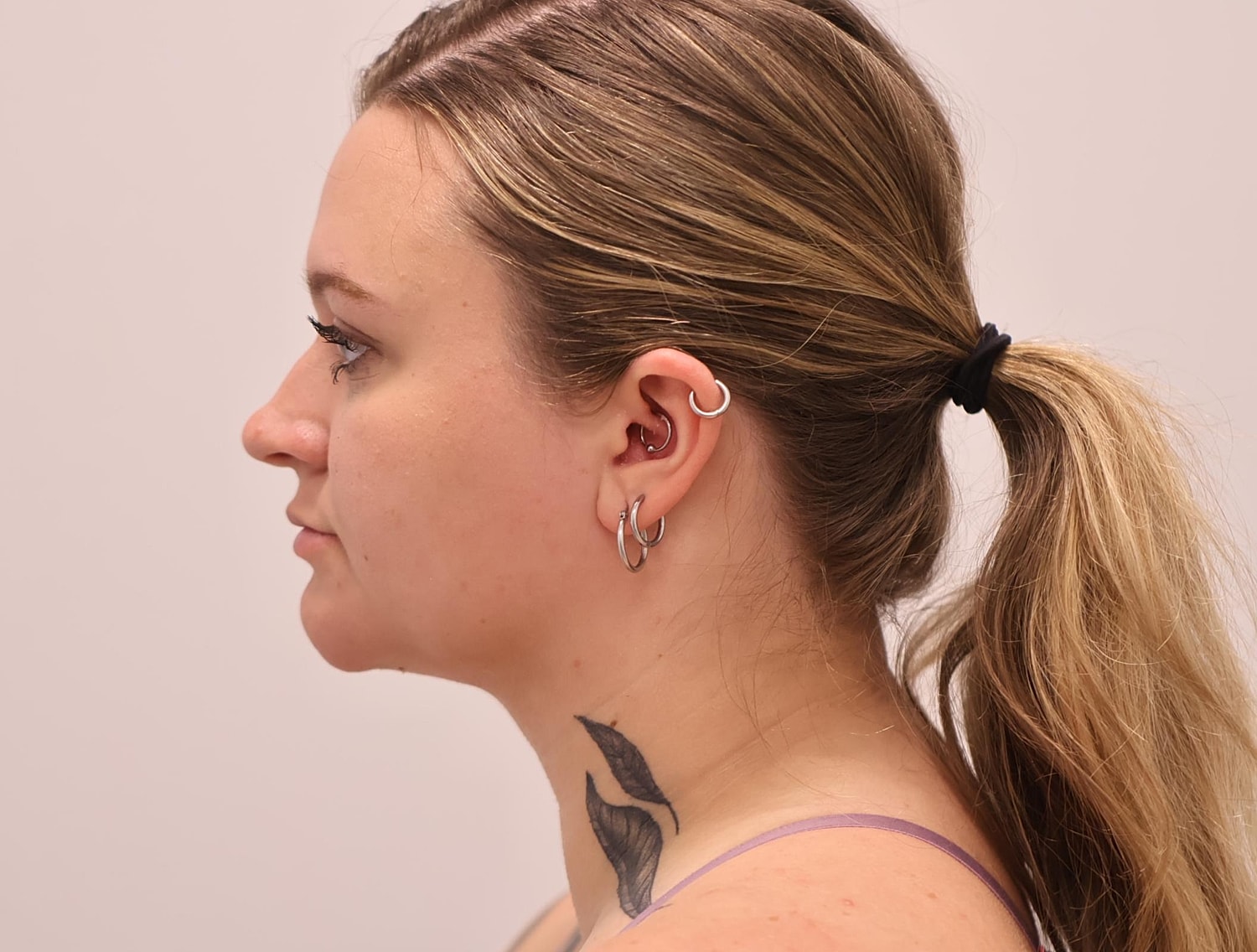 Neck Liposuction Before & After