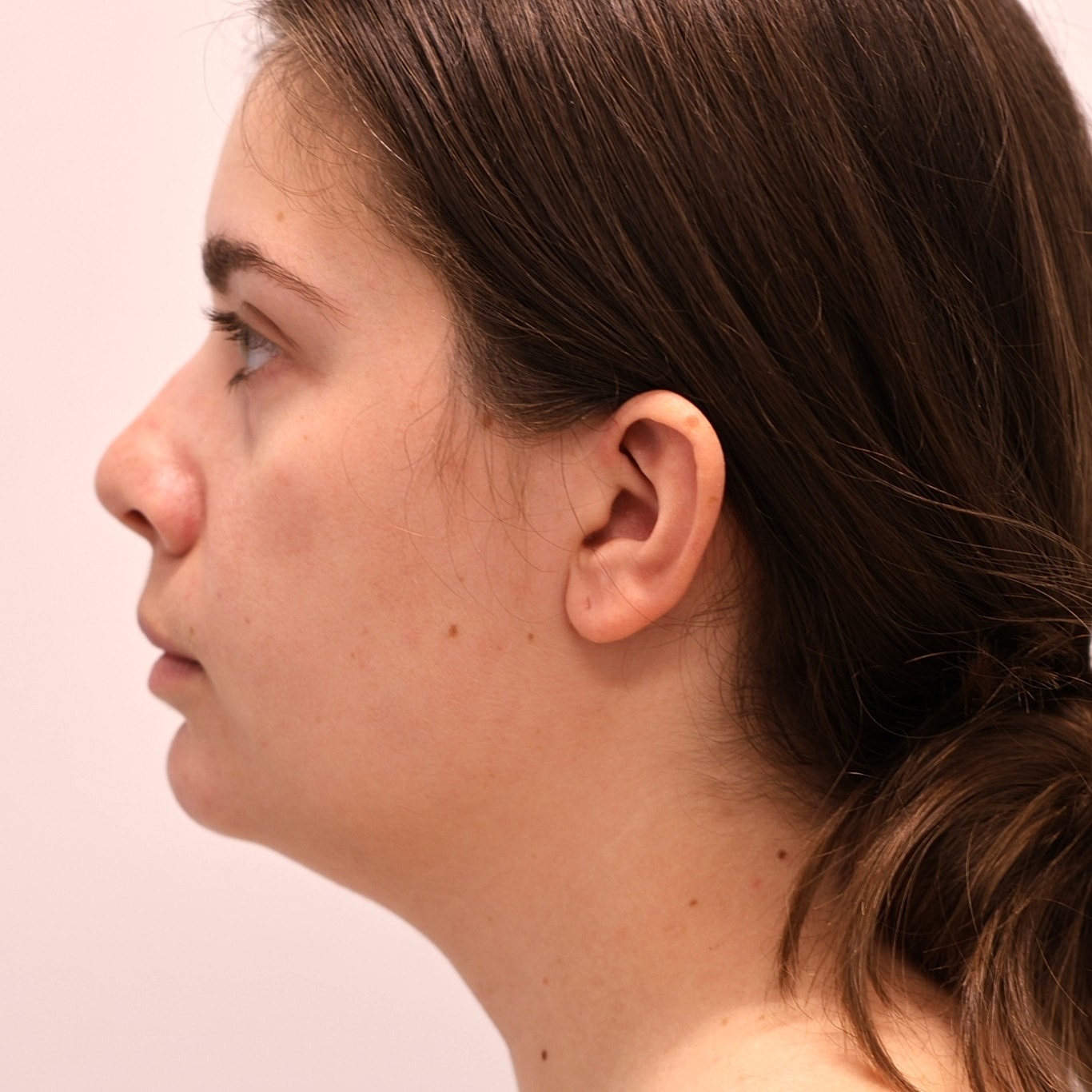 Neck Liposuction Before & After