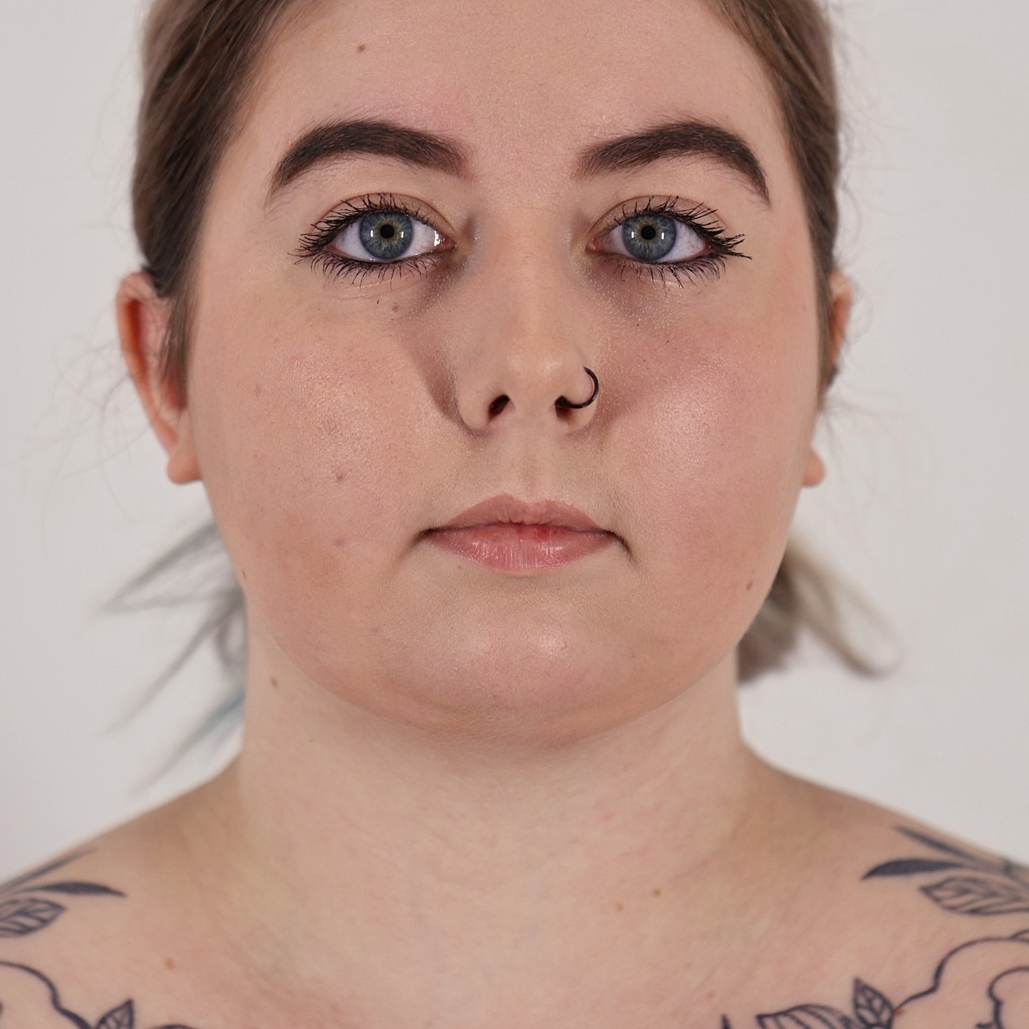 Neck Liposuction Before & After