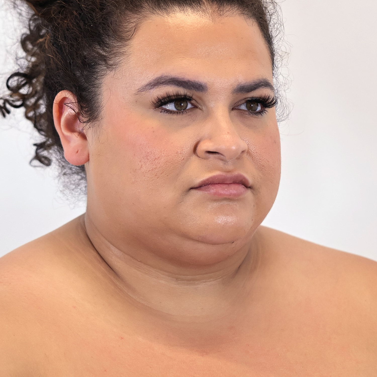 Neck Liposuction Before & After