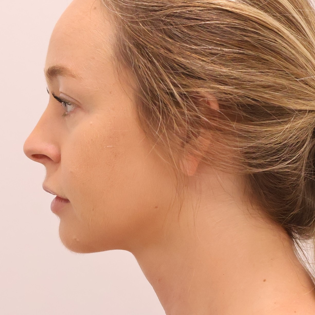 Neck Liposuction Before & After