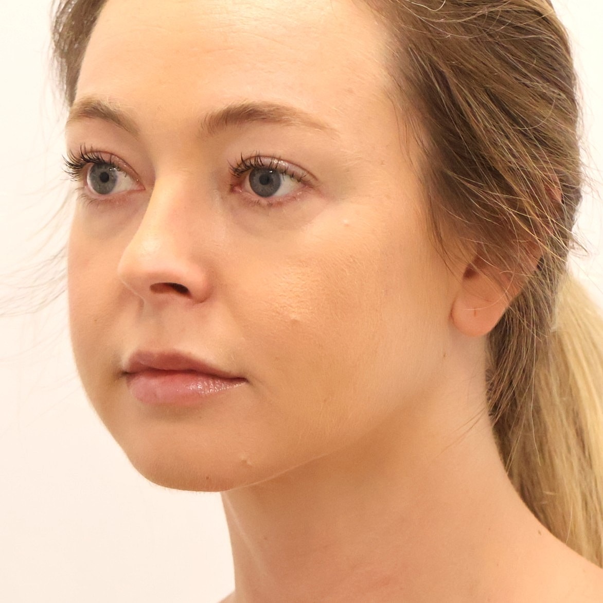 Neck Liposuction Before & After