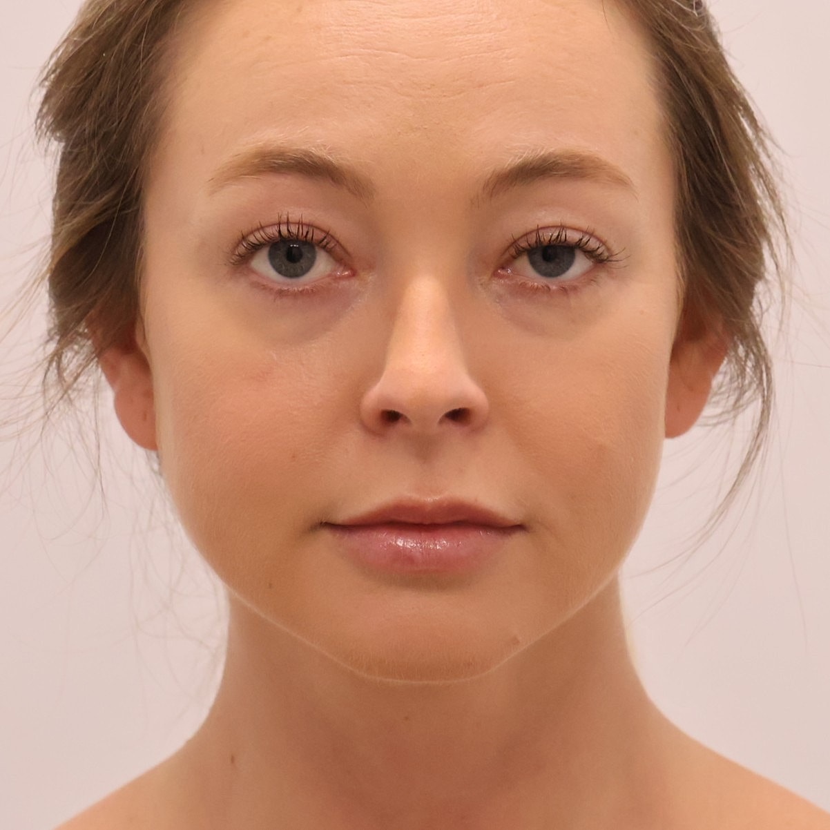 Neck Liposuction Before & After