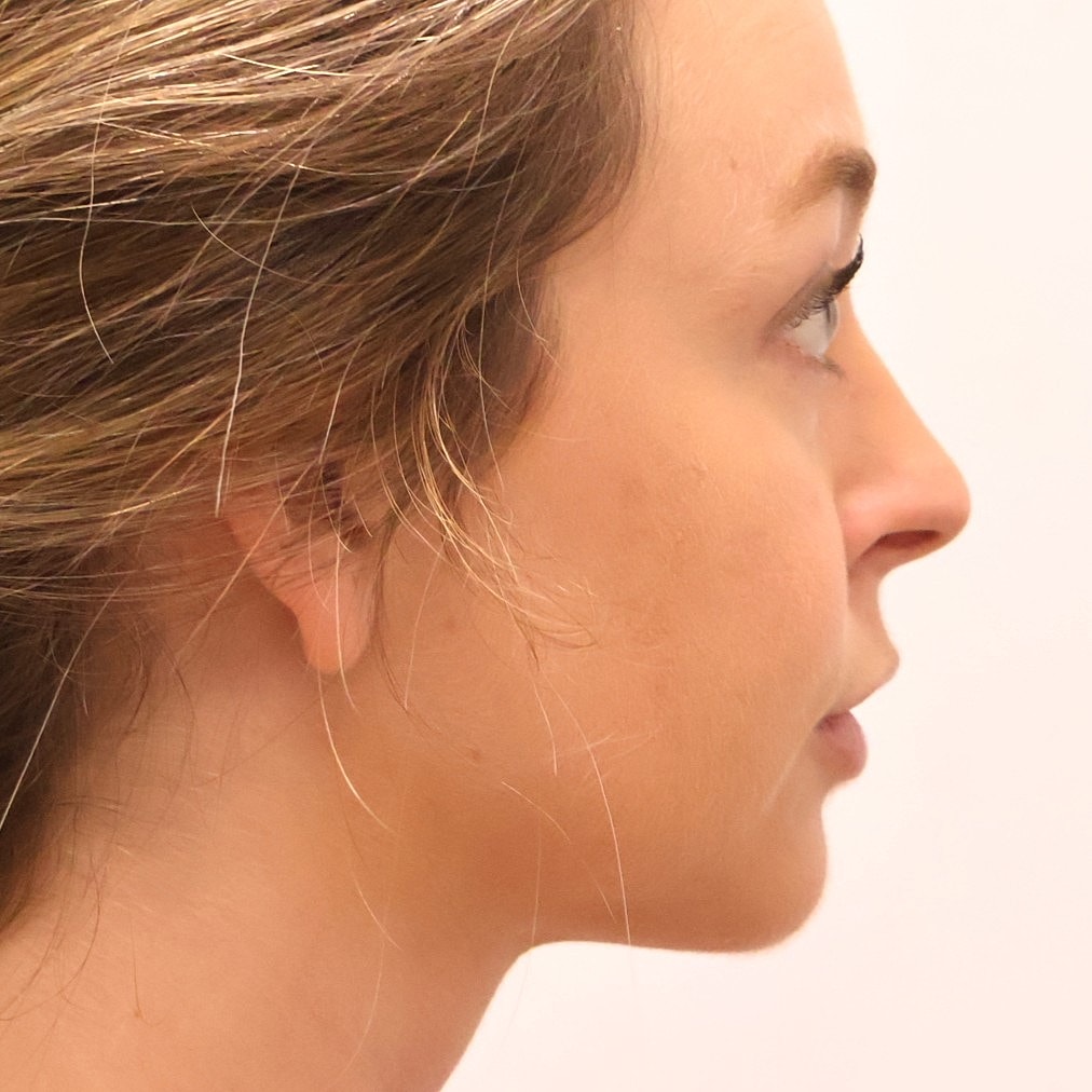 Neck Liposuction Before & After