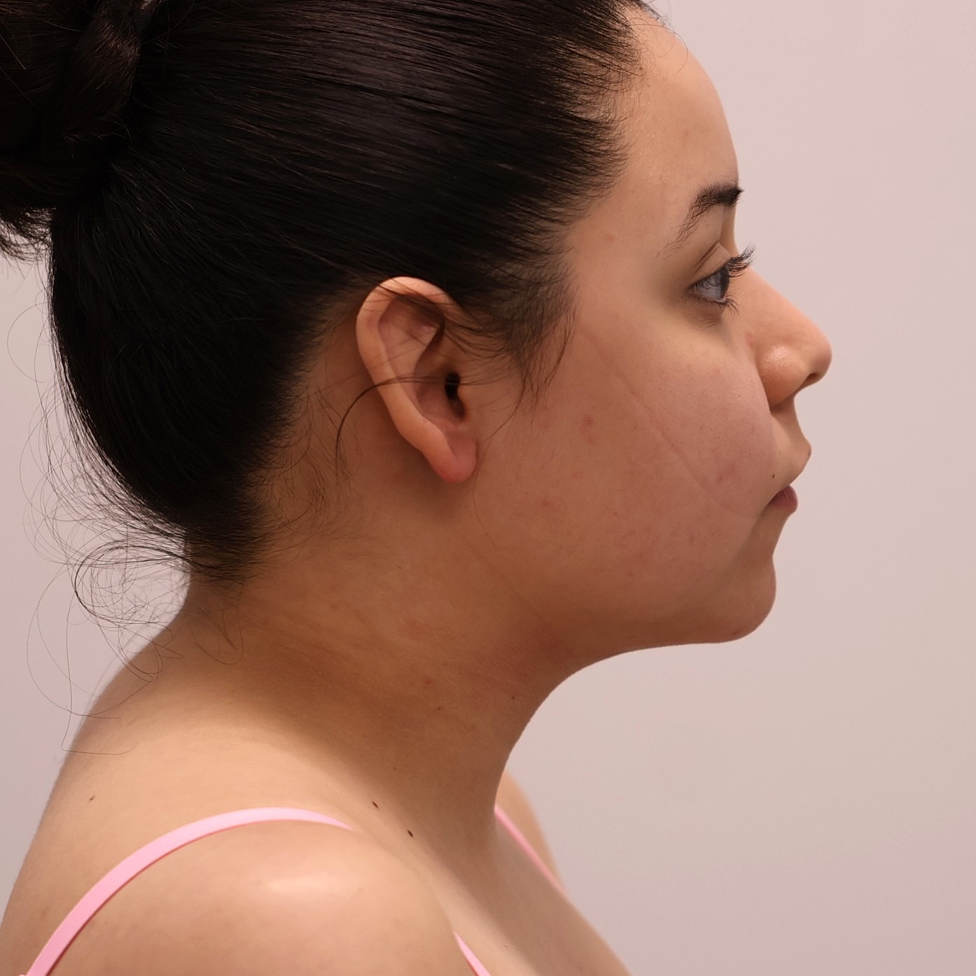 Neck Liposuction Before & After