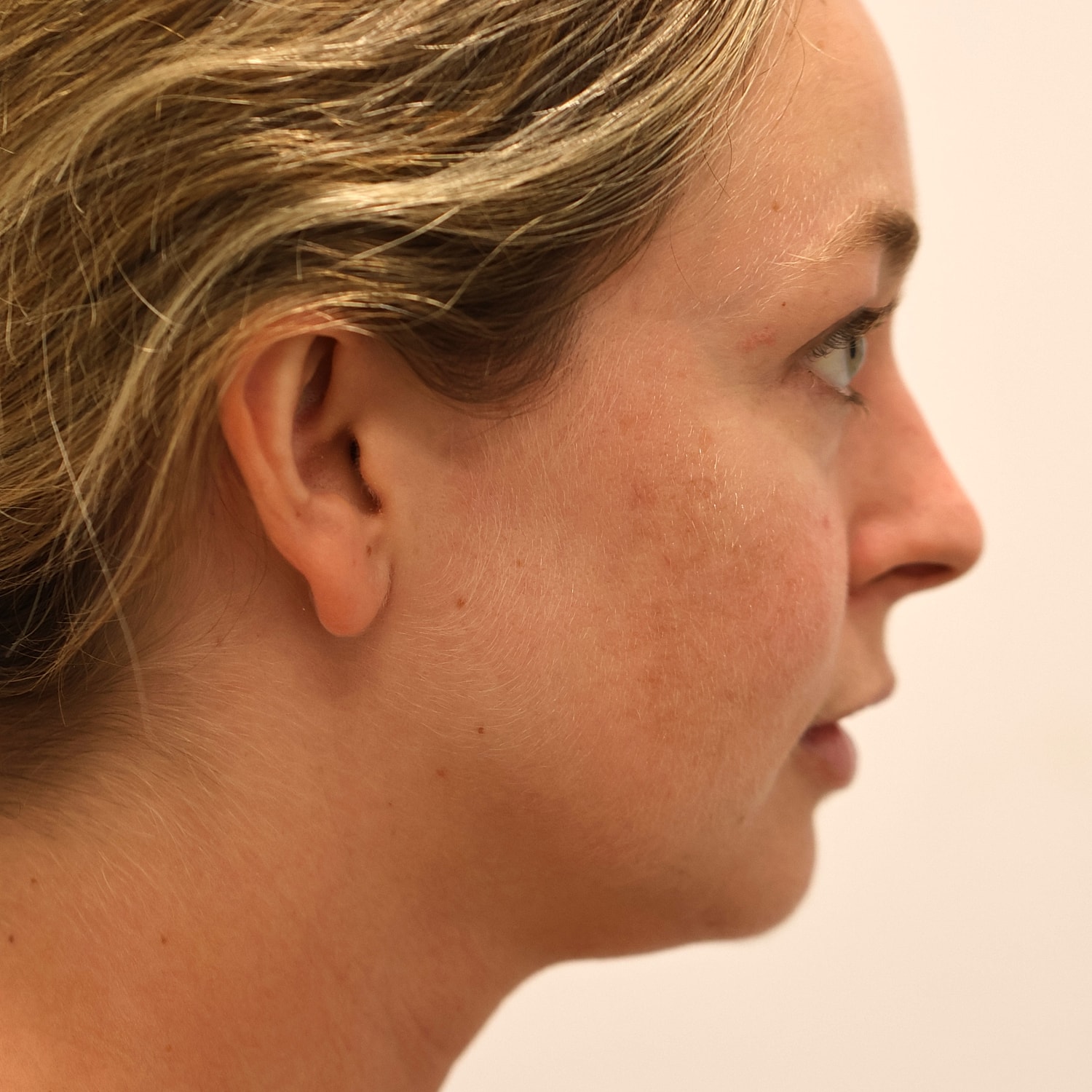 Neck Liposuction Before & After