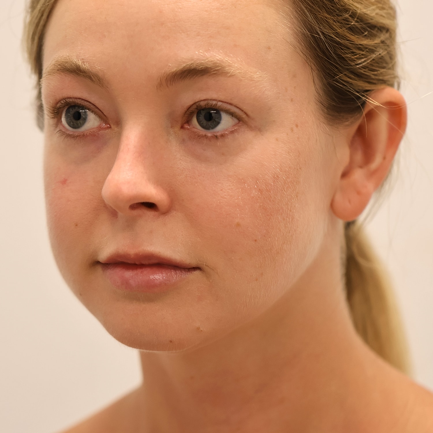 Neck Liposuction Before & After