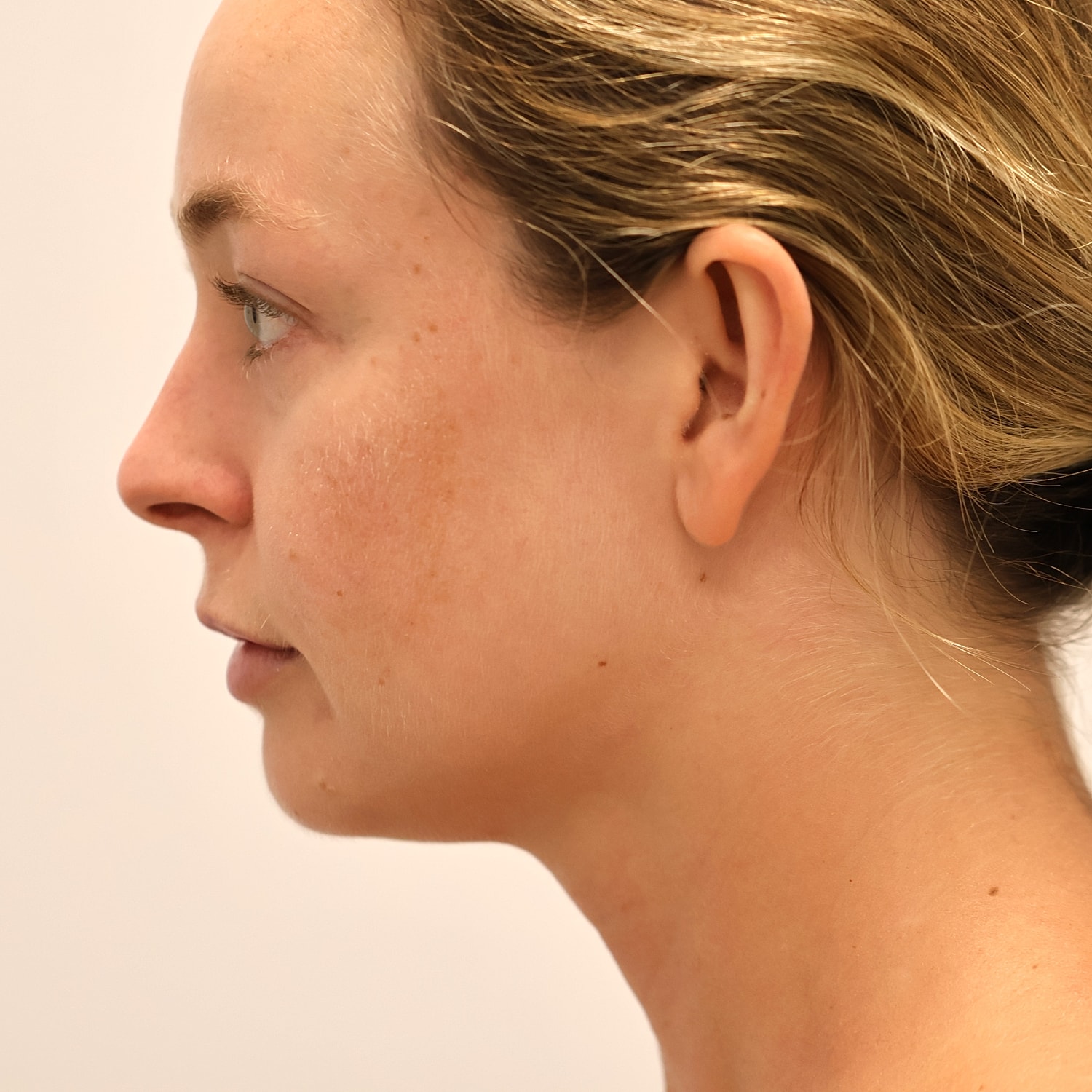 Neck Liposuction Before & After
