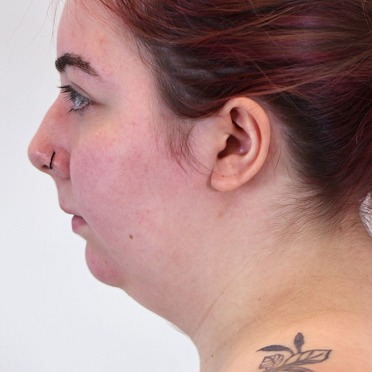Neck Liposuction Before & After
