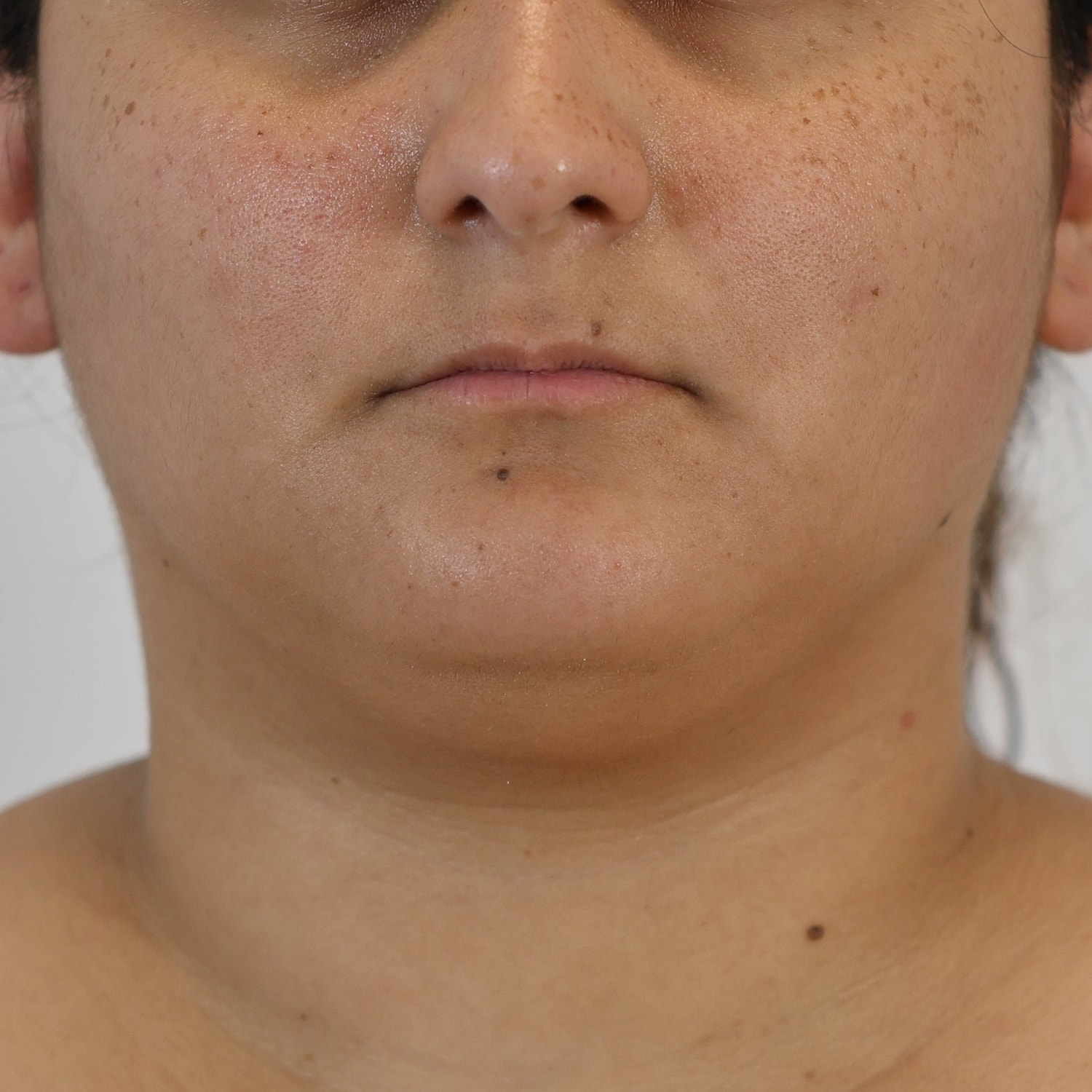 Neck Liposuction Before & After