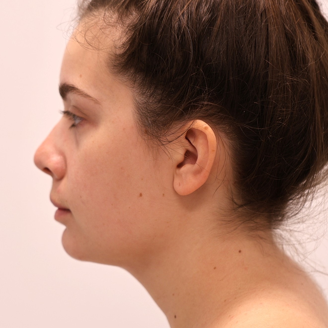 Neck Liposuction Before & After