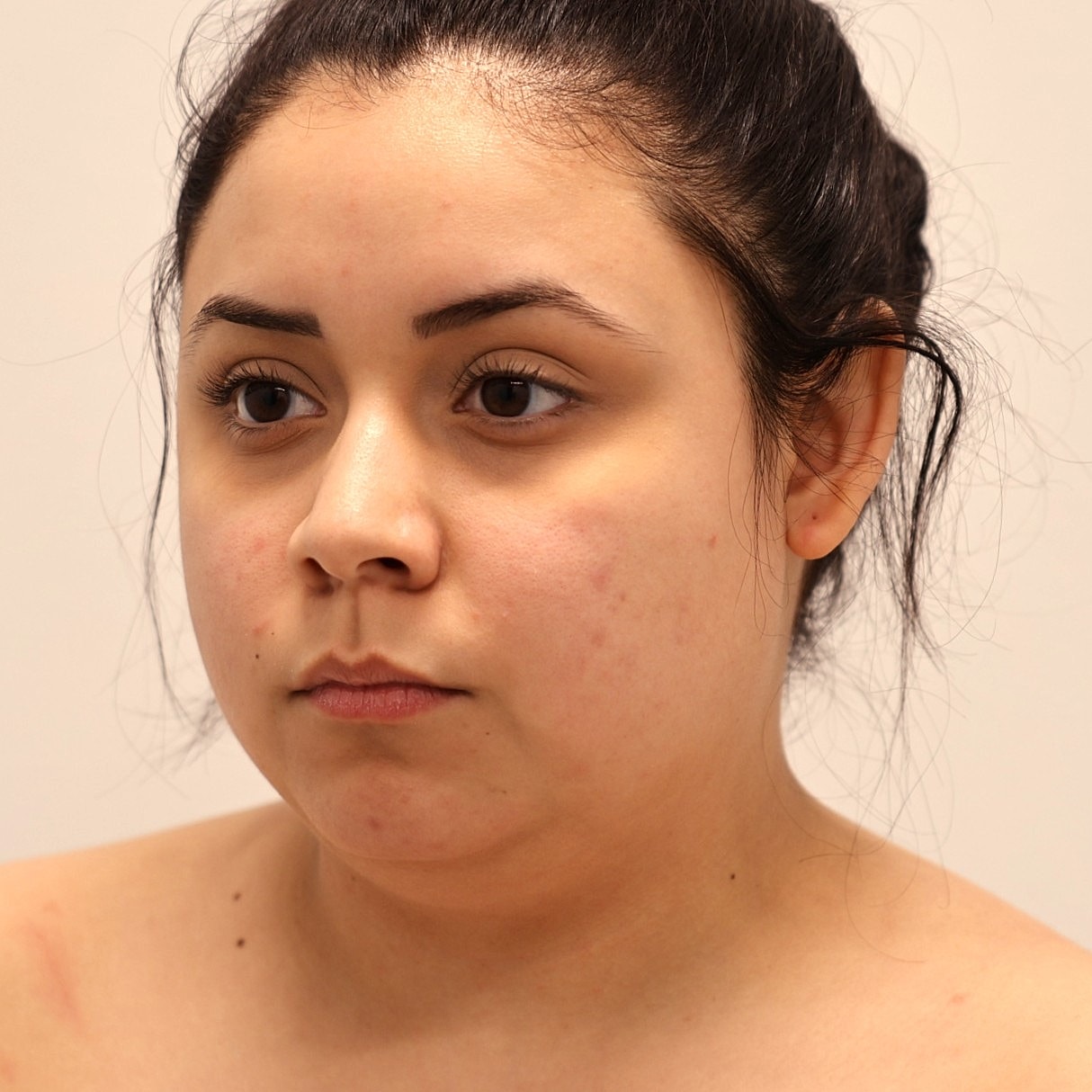 Neck Liposuction Before & After