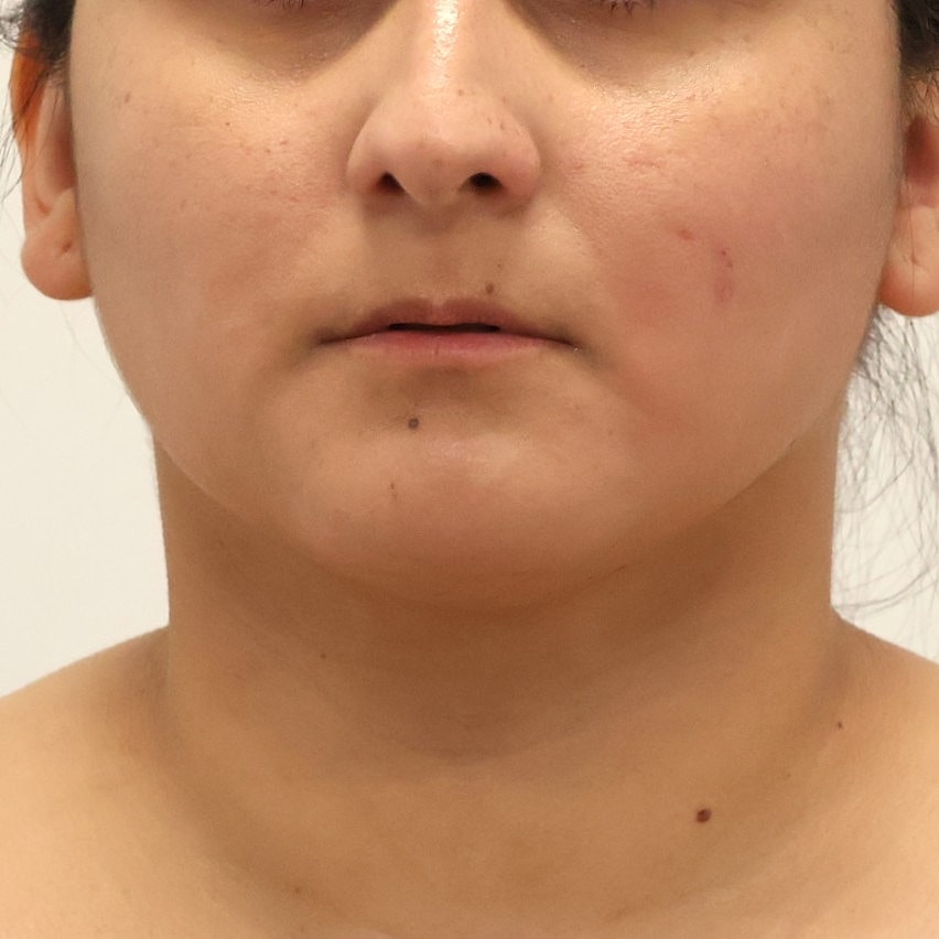 Neck Liposuction Before & After
