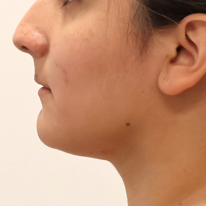Neck Liposuction Before & After