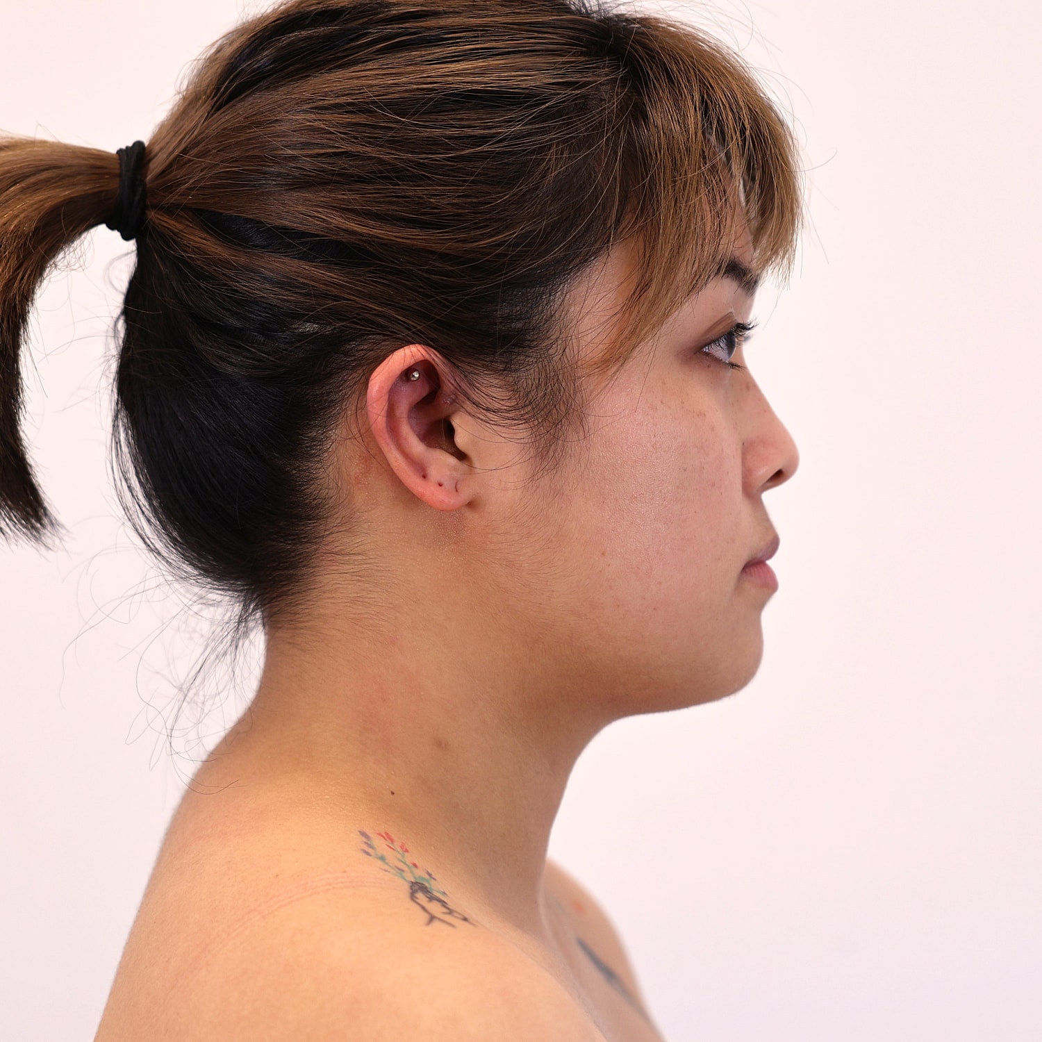 Neck Liposuction Before & After