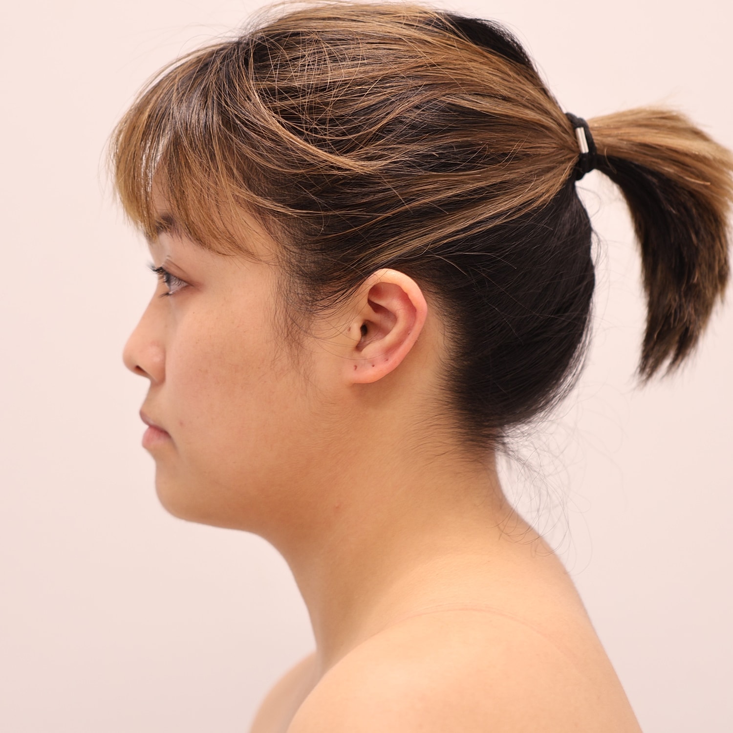 Neck Liposuction Before & After