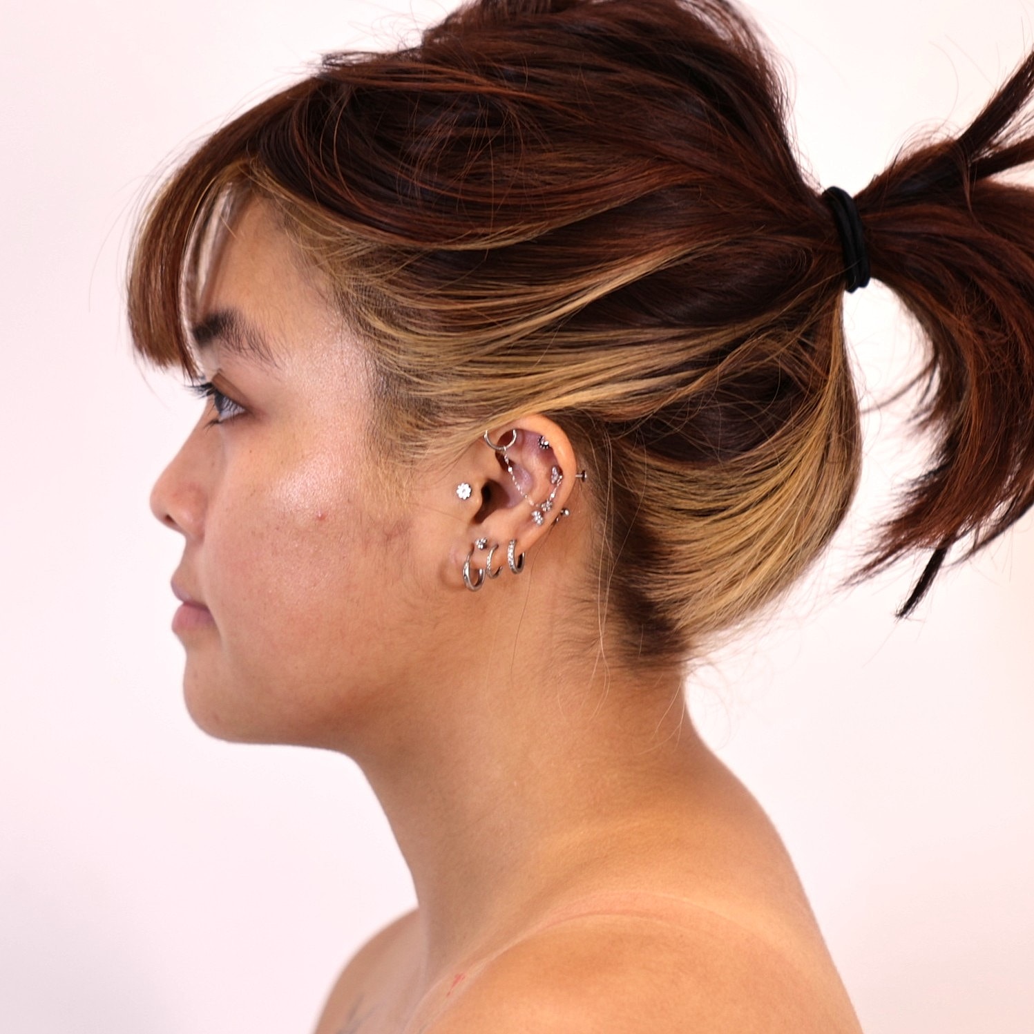 Neck Liposuction Before & After