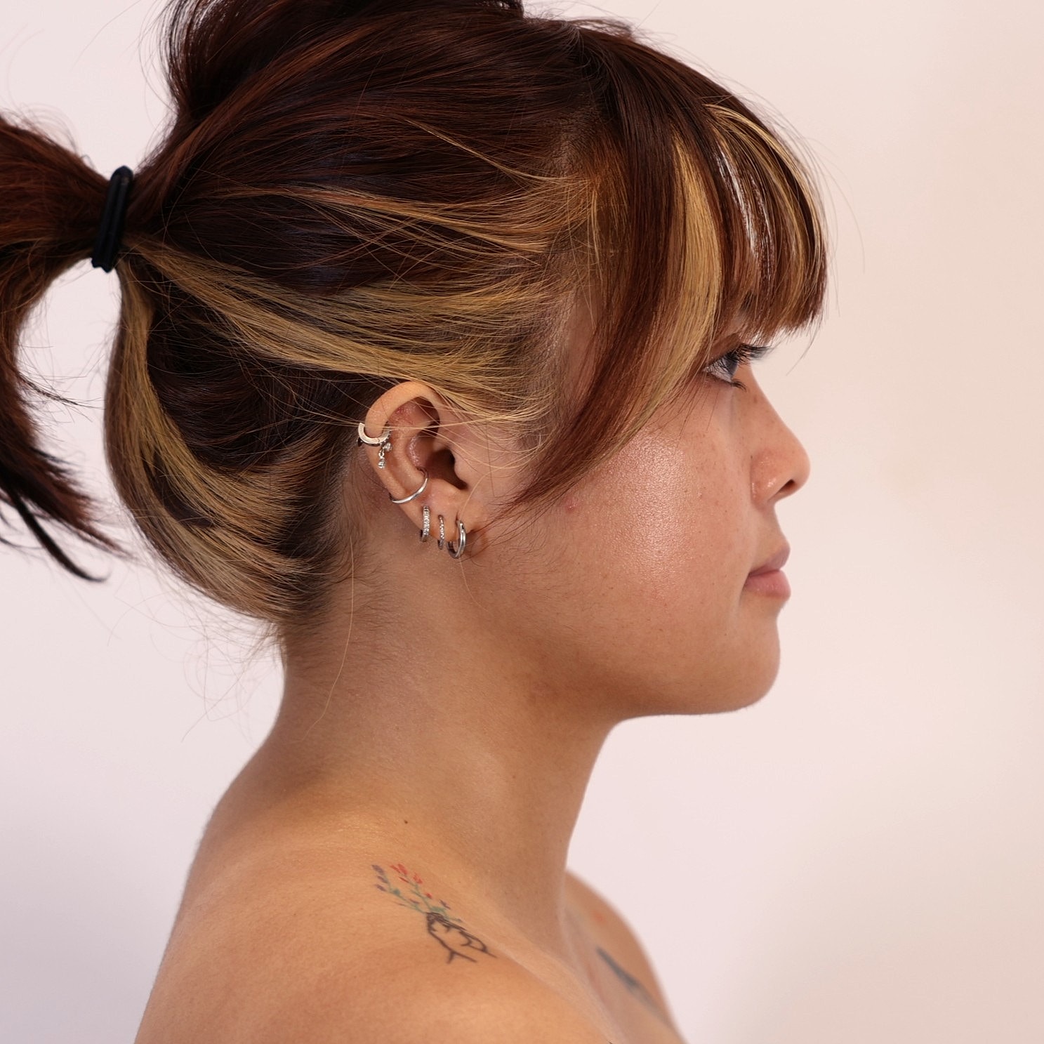 Neck Liposuction Before & After