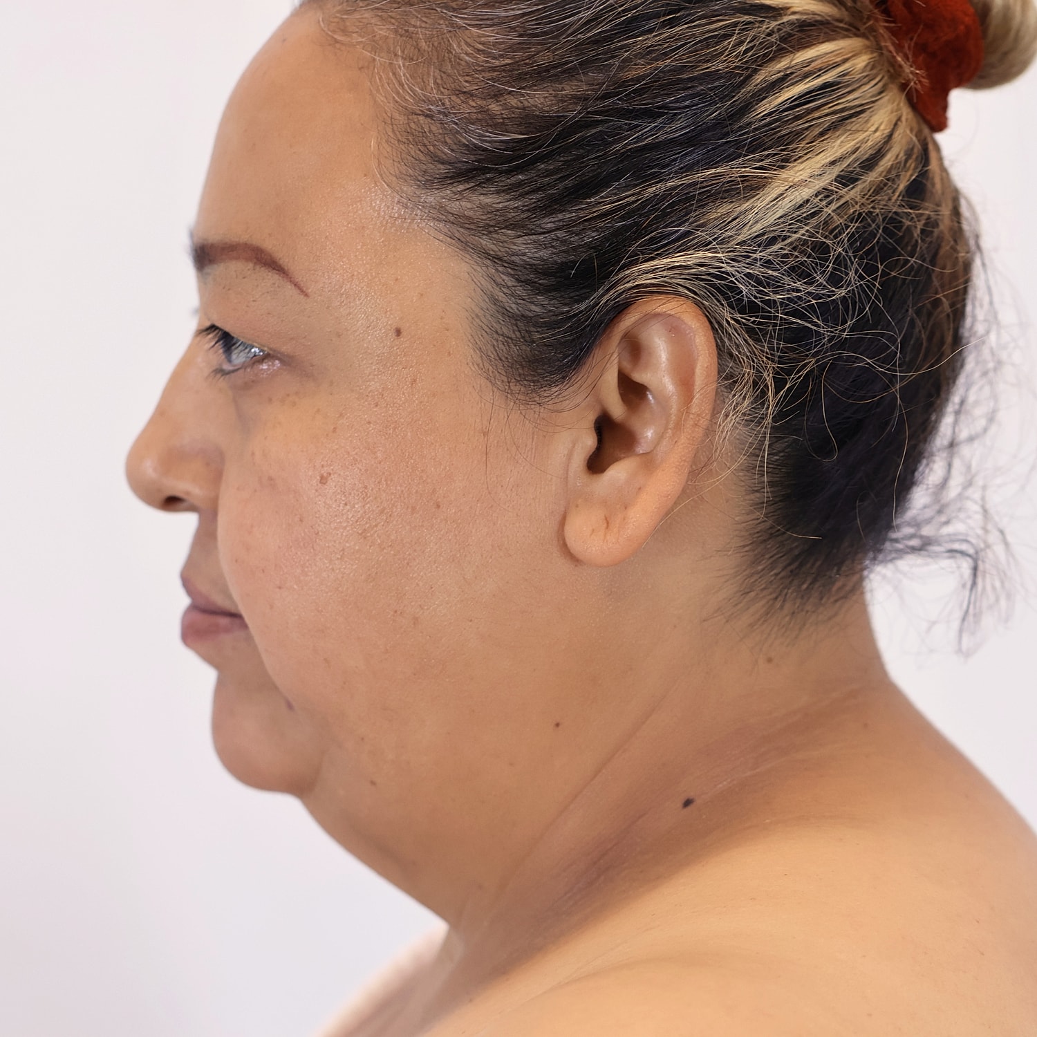 Neck Liposuction Before & After