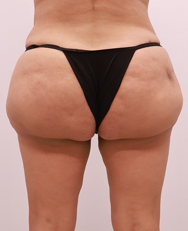 Aveli Cellulite Treatment Before & After