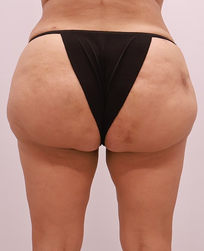 Aveli Cellulite Treatment Before & After