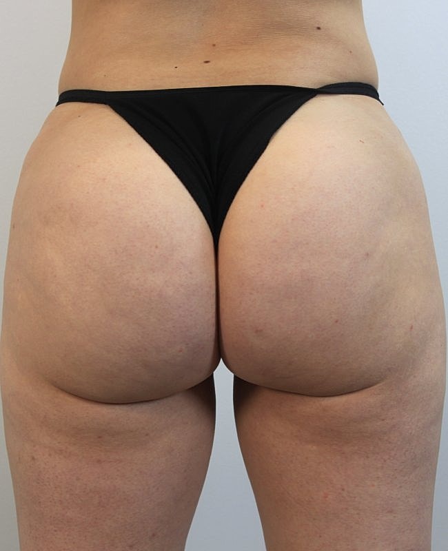 Aveli Cellulite Treatment Before & After